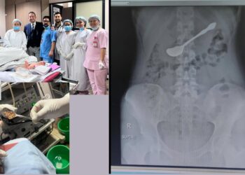 पेटमा अड्किएको चम्चा नर्भिकका चिकित्सकले बिना शल्यक्रिया निकाले