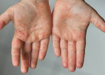 काठमाडौंका बालबालिकामा देखियो दादुरा संक्रमण