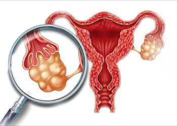 पाठेघरको क्यान्सरबाट कसरी बच्ने