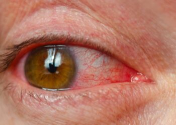 आँखा पाक्ने रोगबाट बच्न के गर्ने, के नगर्ने ?